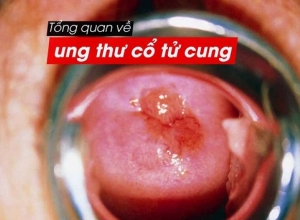 Tiền ung thư cổ tử cung: Nguyên nhân là gì?  